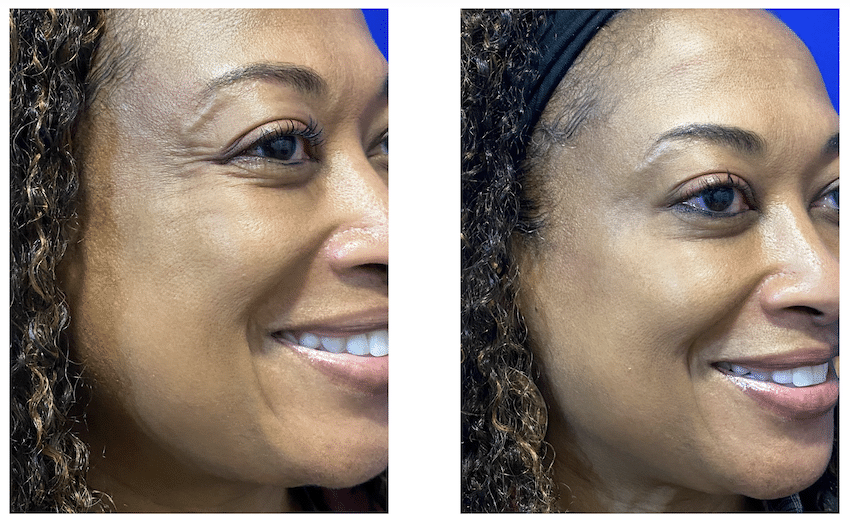 A before-and-after image of a patient who received Botox for crow's feet, with visible improvements to the appearance of the wrinkles in the afterimage. Wrinkle relaxers like Botox can be used alongside good skin care near Colleyville, TX, to help prolong the results and improve the skin's health. Show less